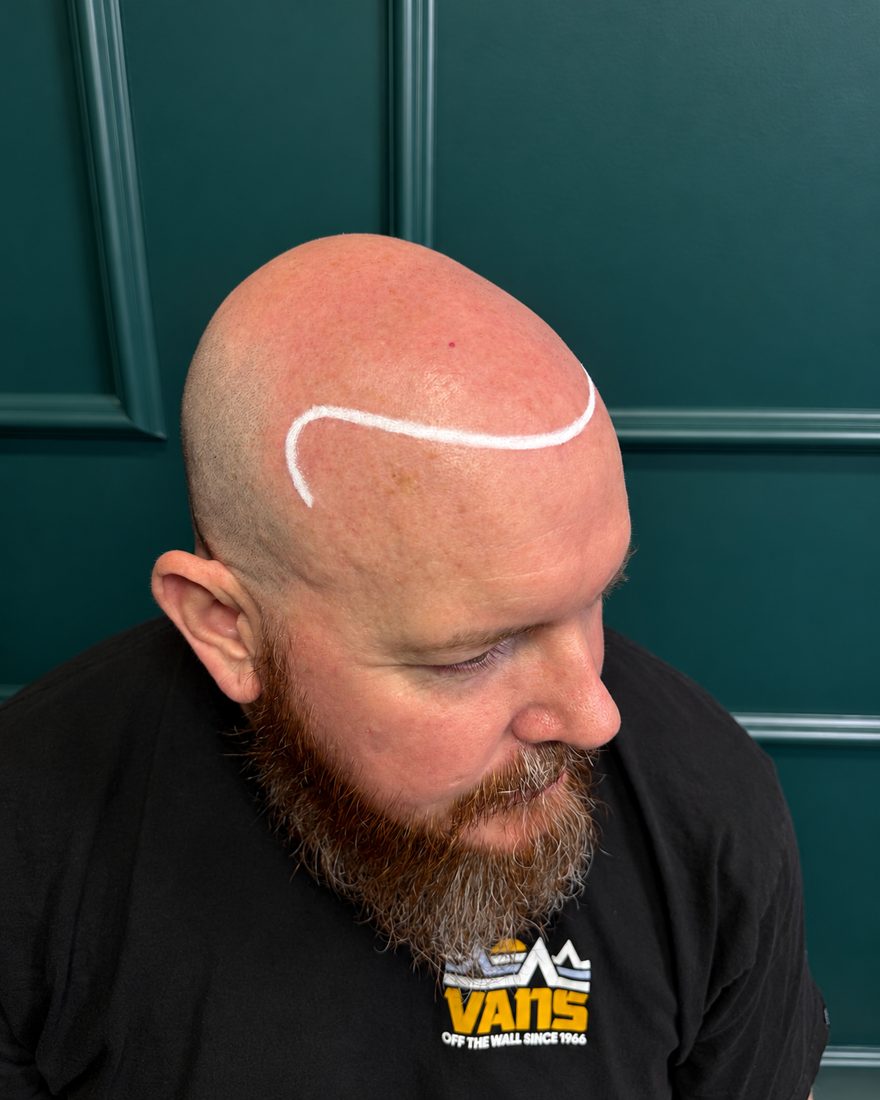 Hairline design, side view