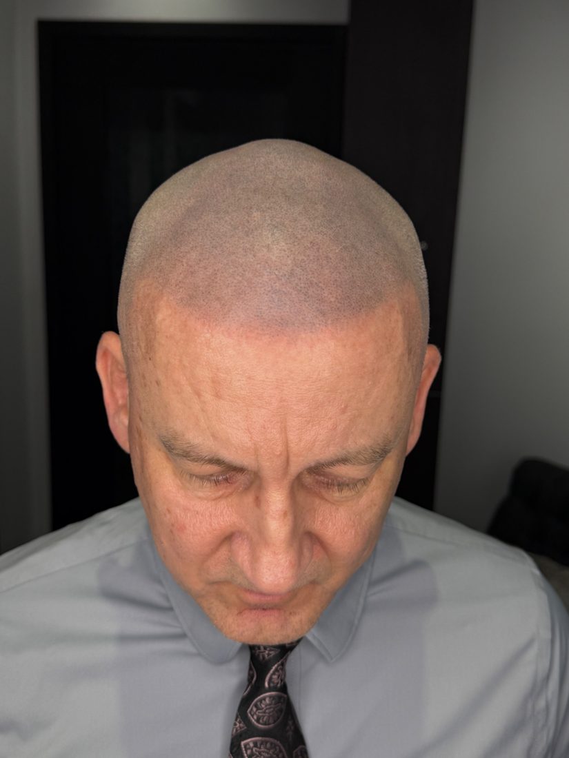 Same client after session three, front view