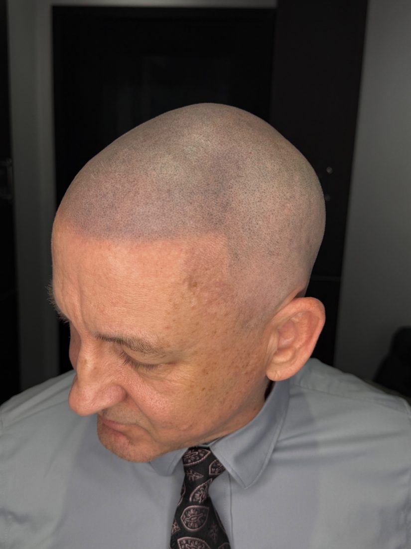 After, left side view