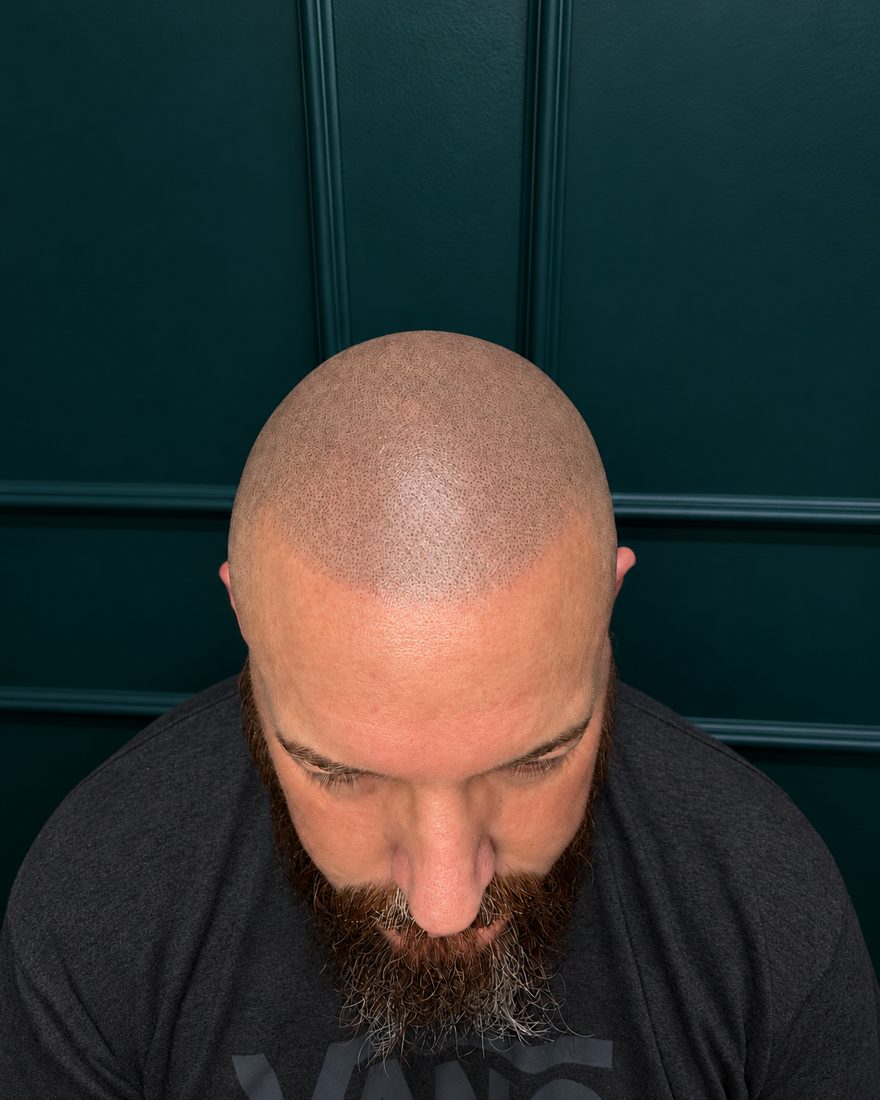 Client's finished SMP hairline, top view